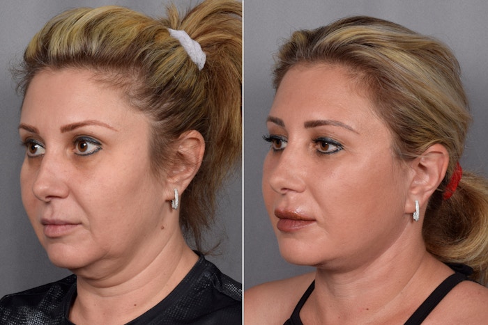 Facelift Before & After Gallery - Patient 177189 - Image 1