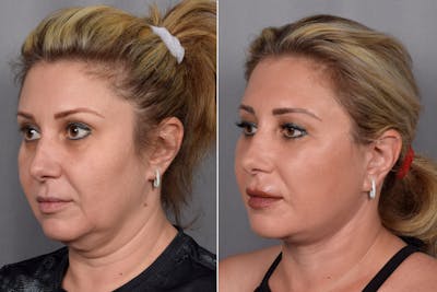 Facelift Before & After Gallery - Patient 177189 - Image 1