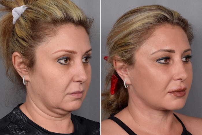 Facelift Before & After Gallery - Patient 177189 - Image 1