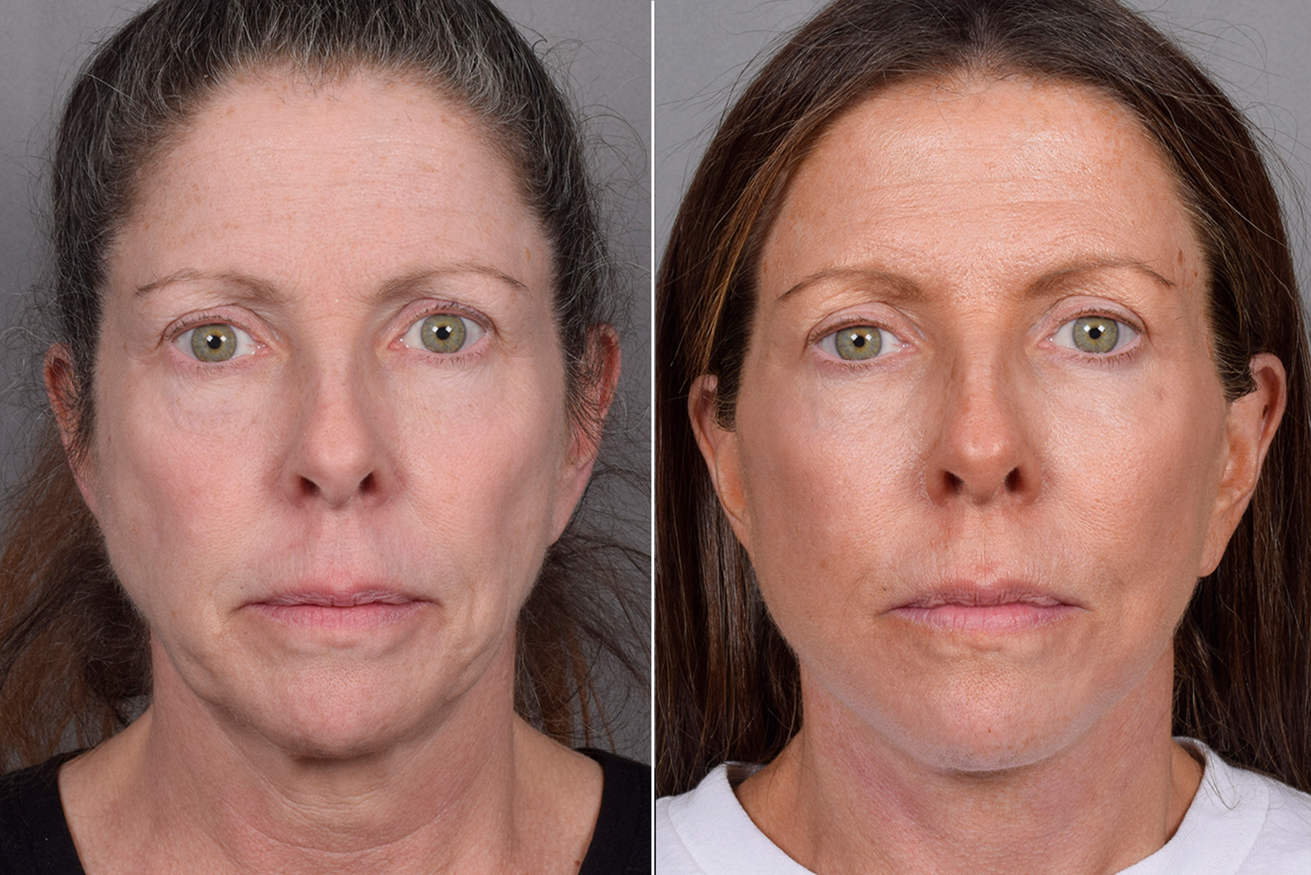 Facelift Before & After Gallery - Patient 359313 - Image 1
