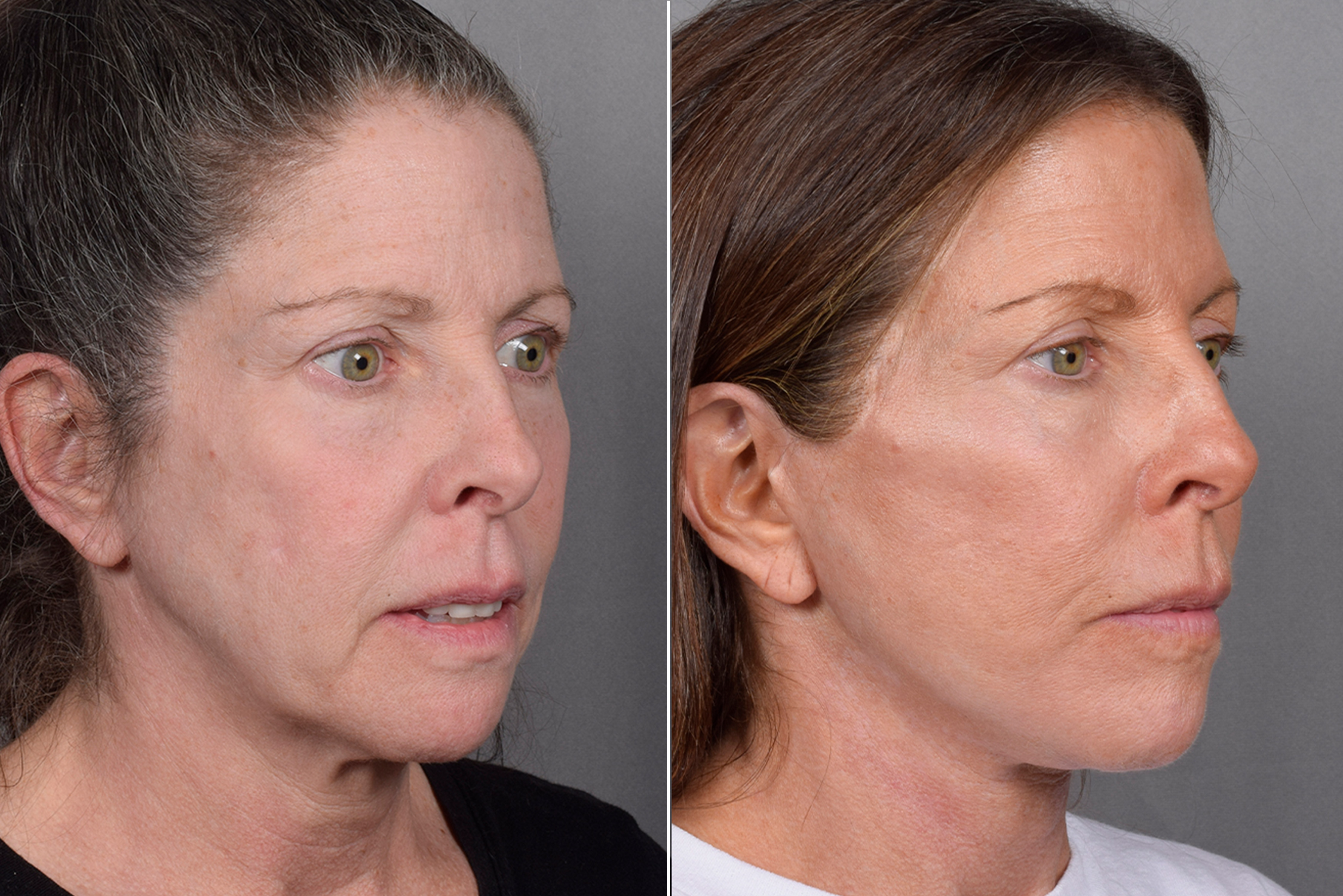 Facelift Before & After Gallery - Patient 359313 - Image 2