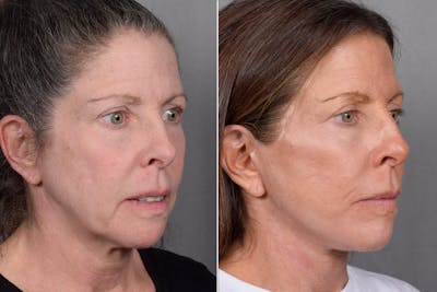 CO2 Laser Before & After Gallery - Patient 408475 - Image 1