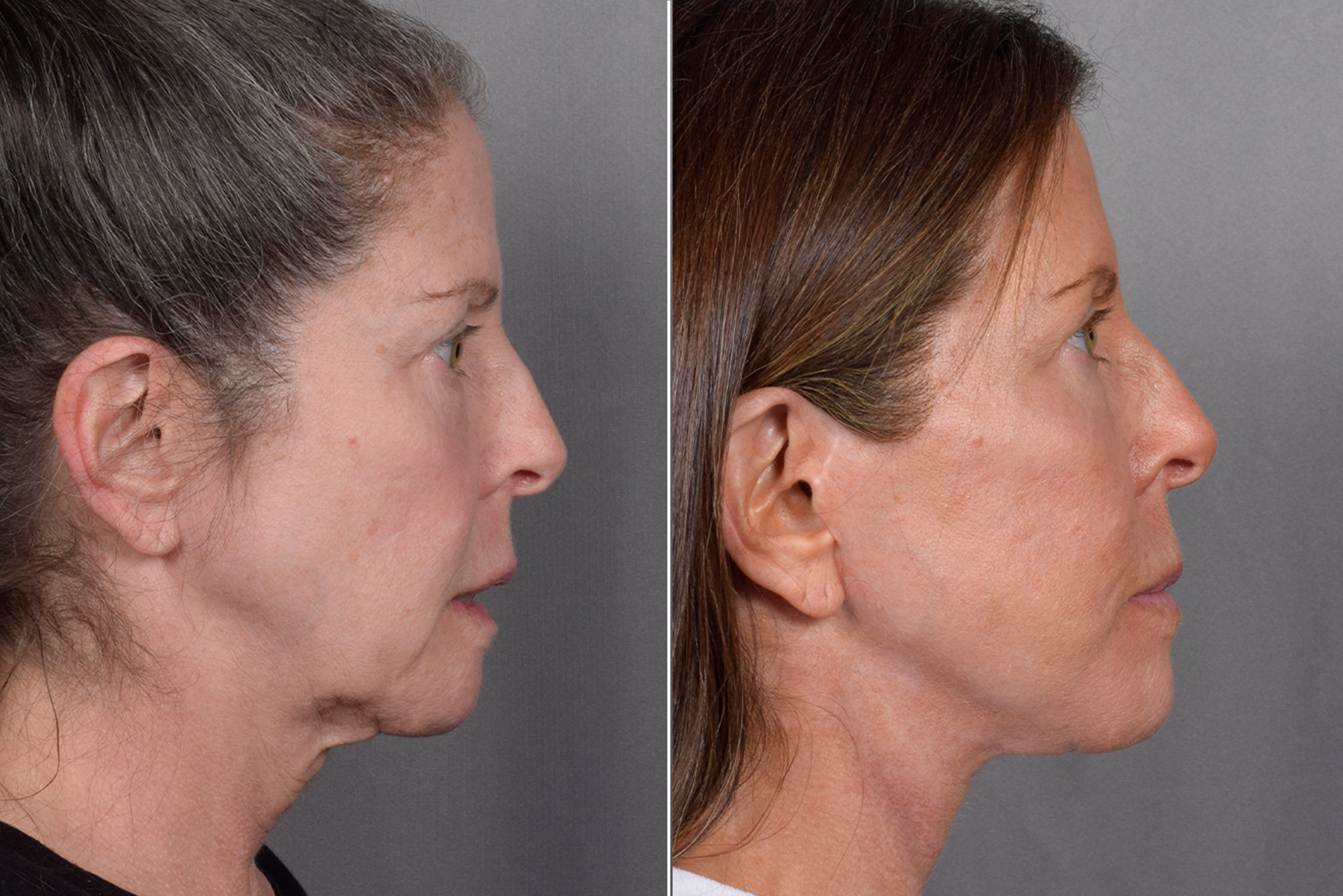 Facelift Before & After Gallery - Patient 359313 - Image 4