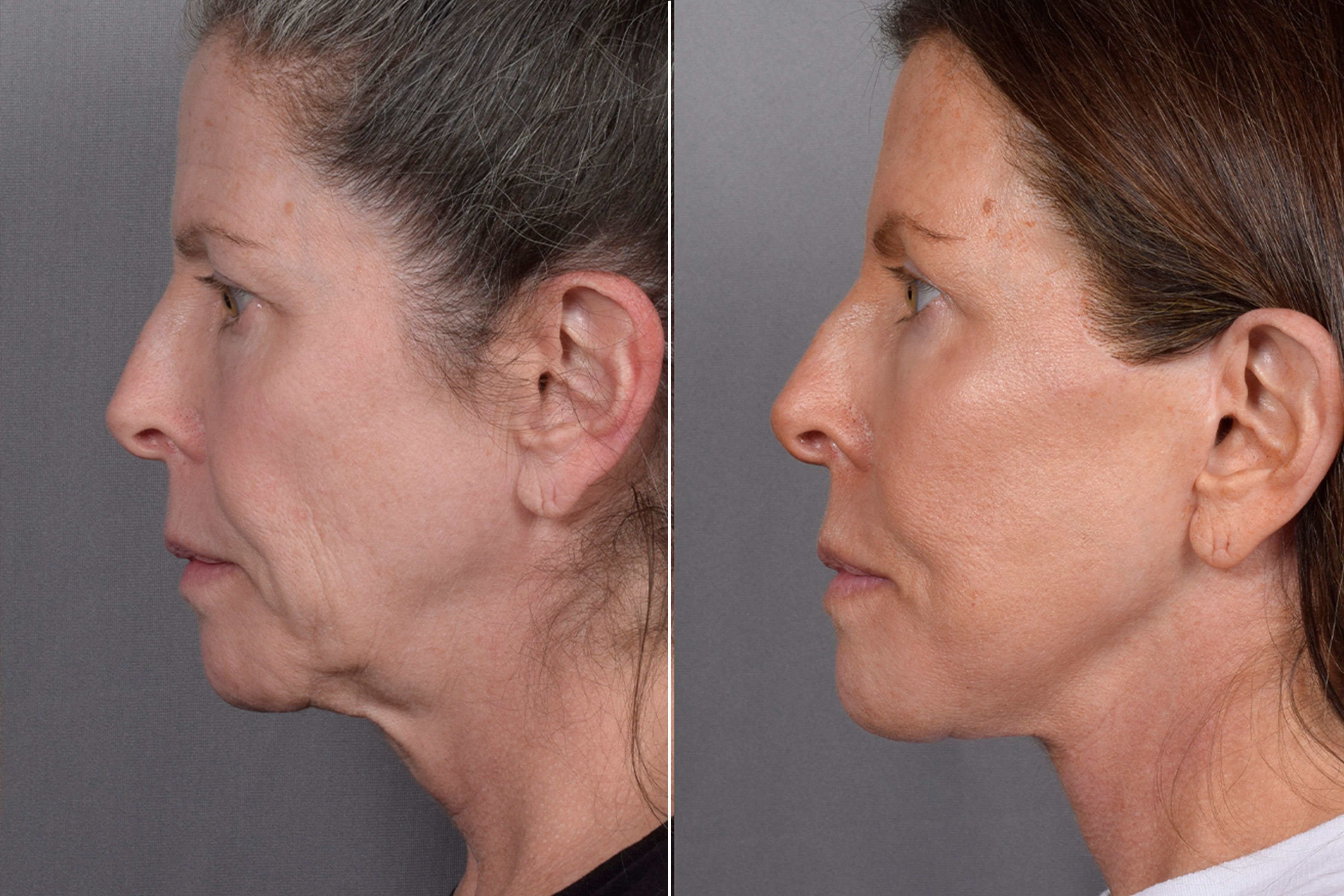 Facelift Before & After Gallery - Patient 359313 - Image 5