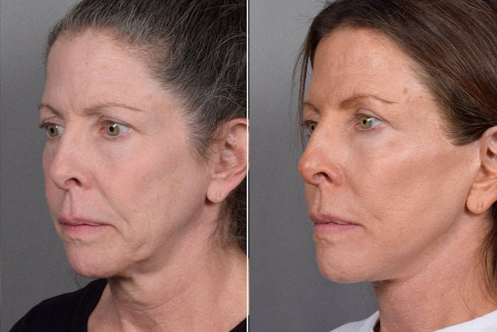 Facelift Before & After Gallery - Patient 359313 - Image 1