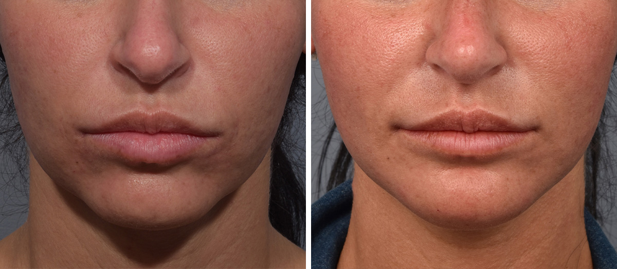 Neck Lift Before & After Gallery - Patient 422138 - Image 3