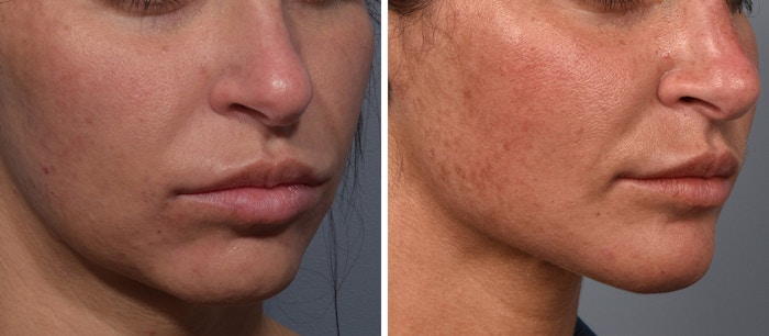 Neck Lift Before & After Gallery - Patient 422138 - Image 1