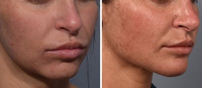 Neck Lift Before & After Gallery - Patient 422138 - Image 1