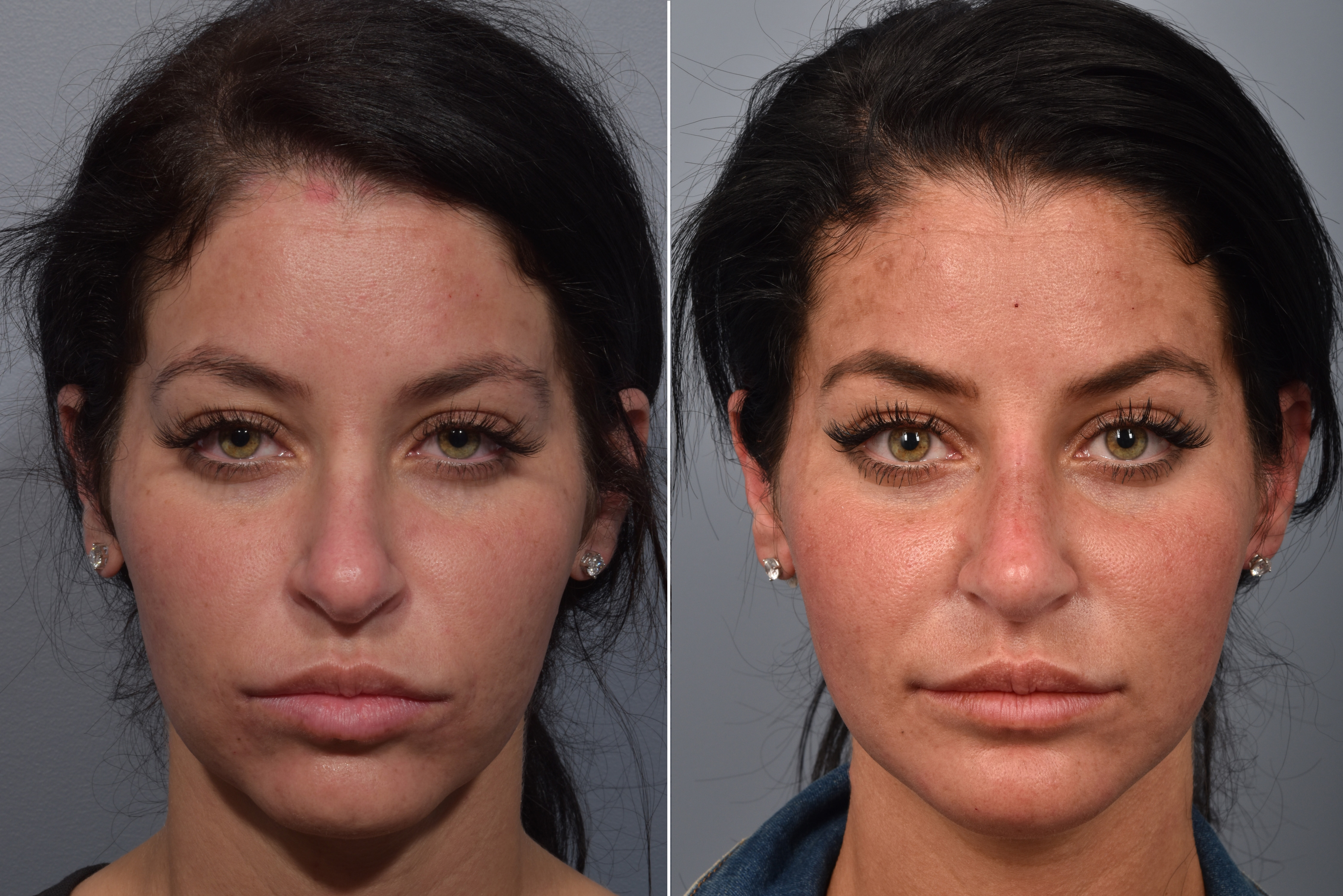 Neck Lift Before & After Gallery - Patient 422138 - Image 8
