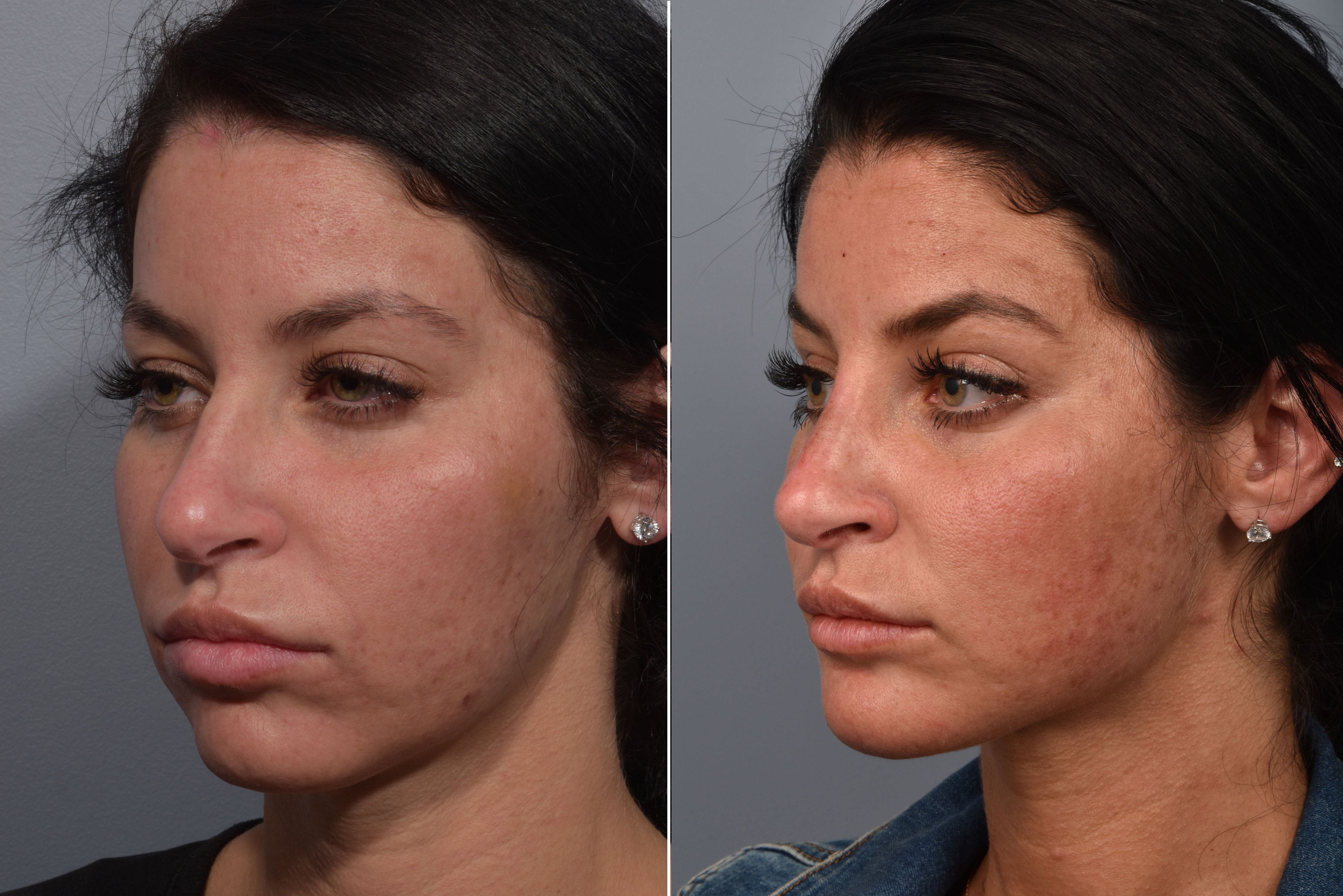 Neck Lift Before & After Gallery - Patient 422138 - Image 9