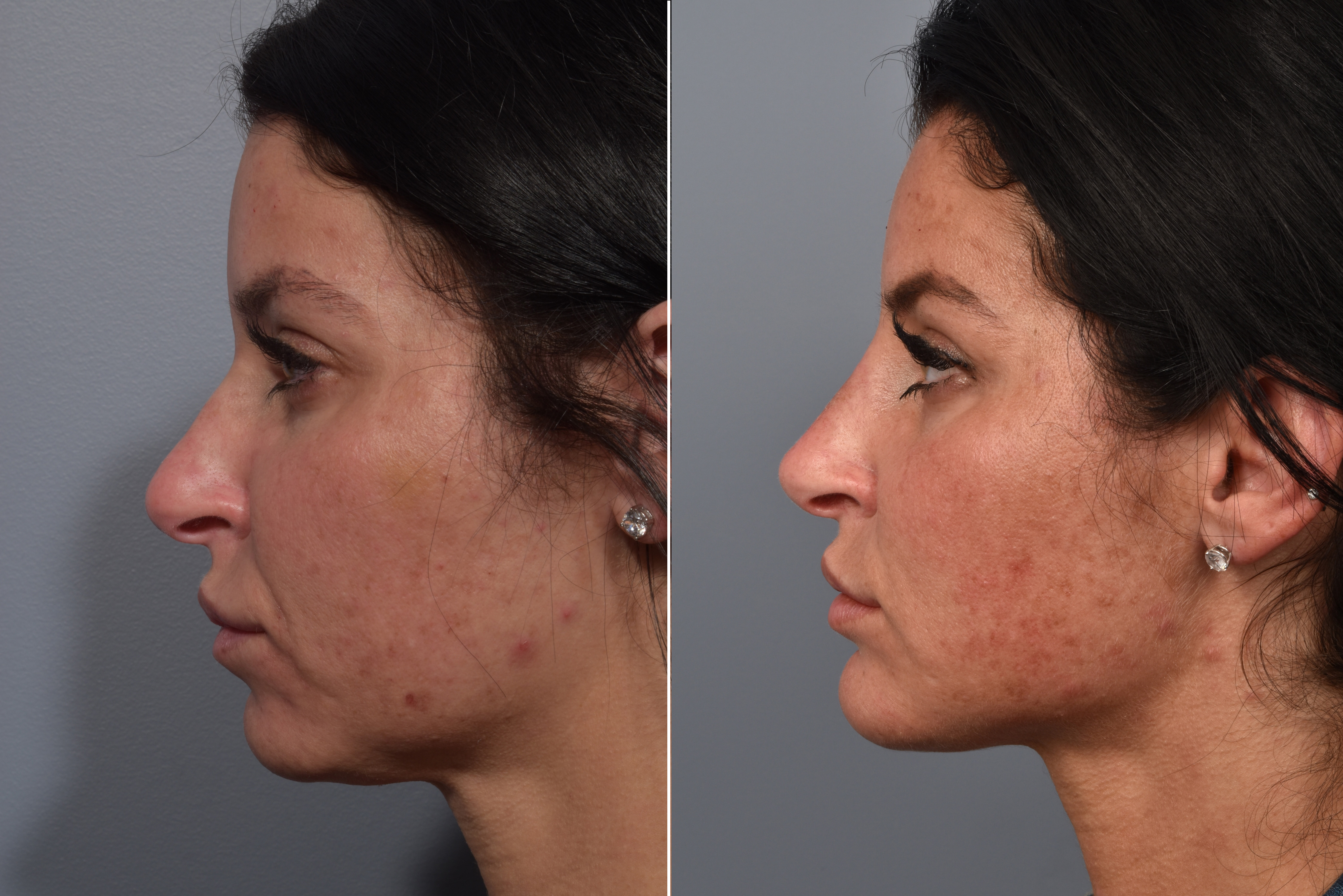 Neck Lift Before & After Gallery - Patient 422138 - Image 10