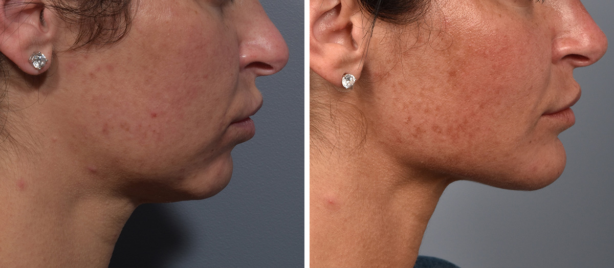 Neck Lift Before & After Gallery - Patient 422138 - Image 2