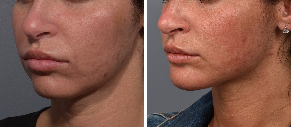 Neck Lift Before & After Gallery - Patient 422138 - Image 4