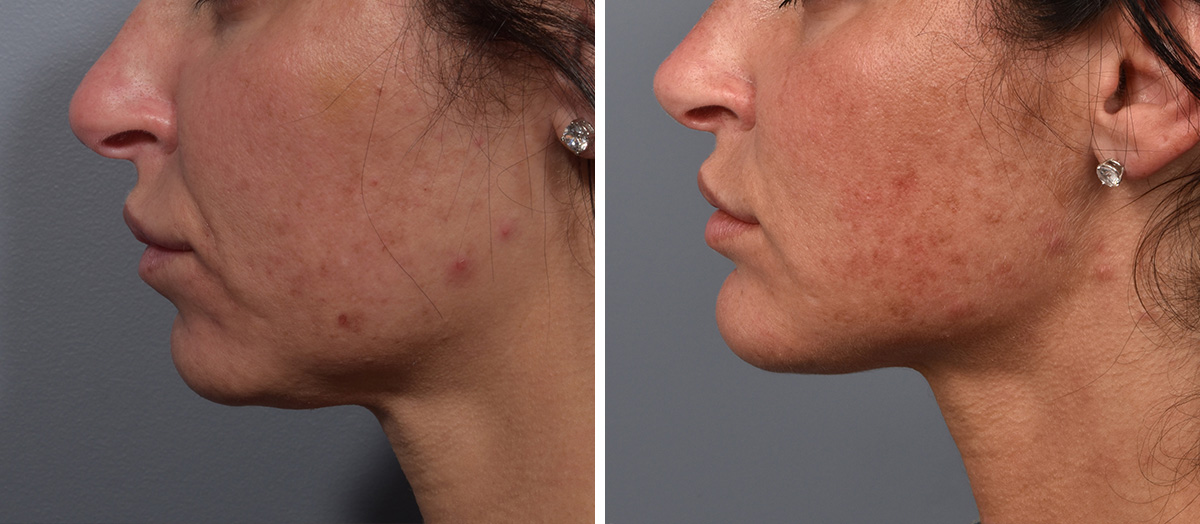 Neck Lift Before & After Gallery - Patient 422138 - Image 5