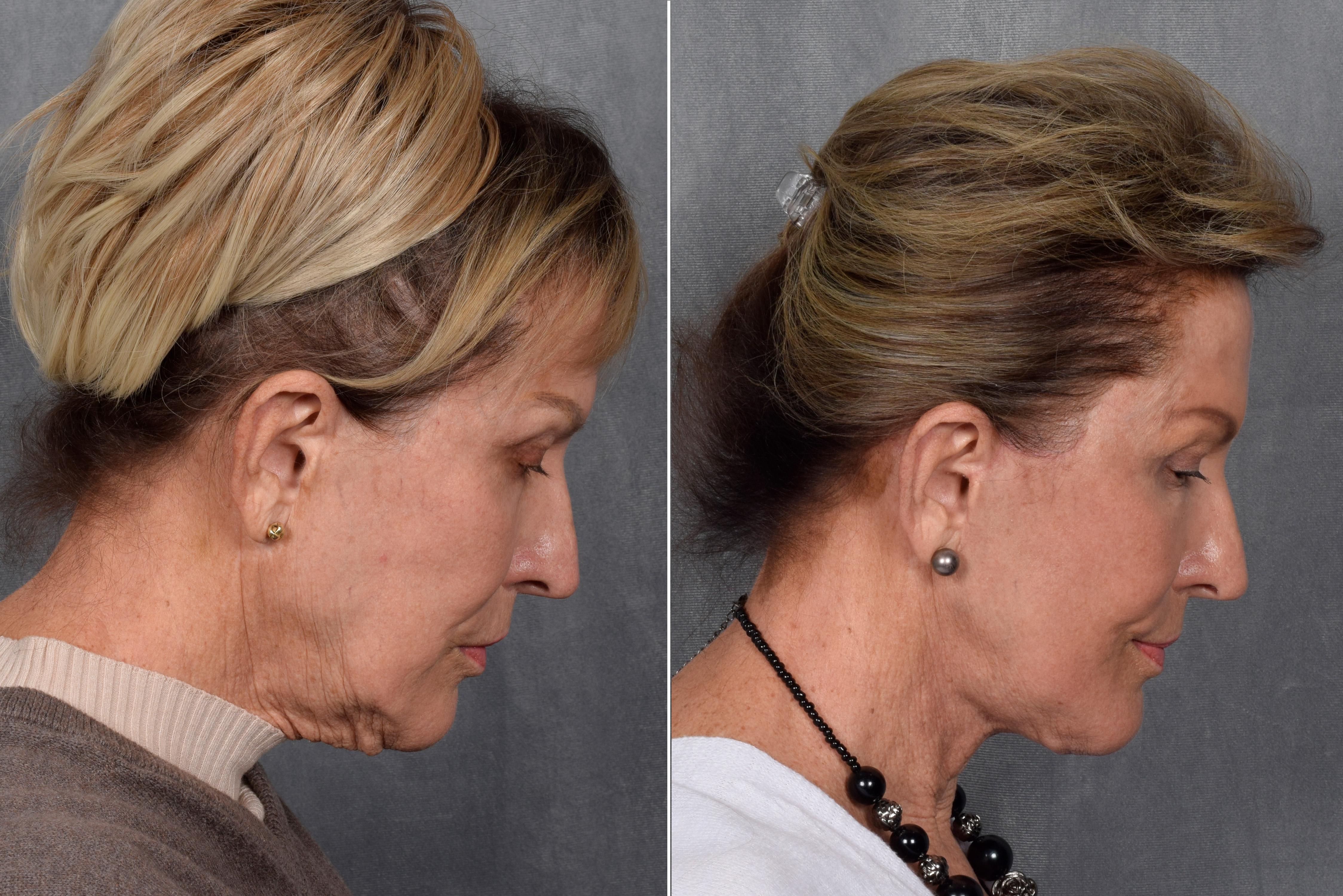 Neck Lift Before & After Gallery - Patient 162270 - Image 10