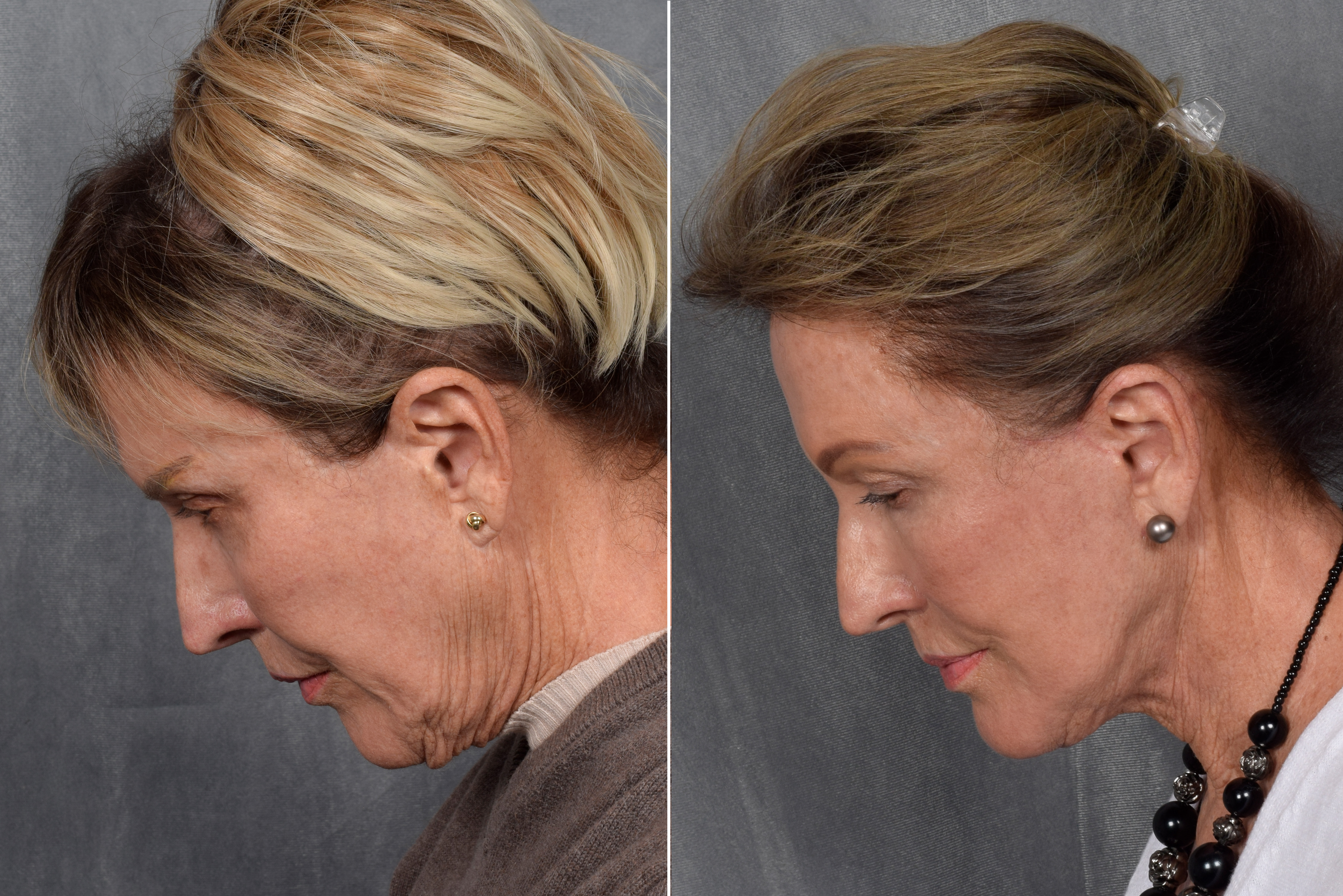 Neck Lift Before & After Gallery - Patient 162270 - Image 14