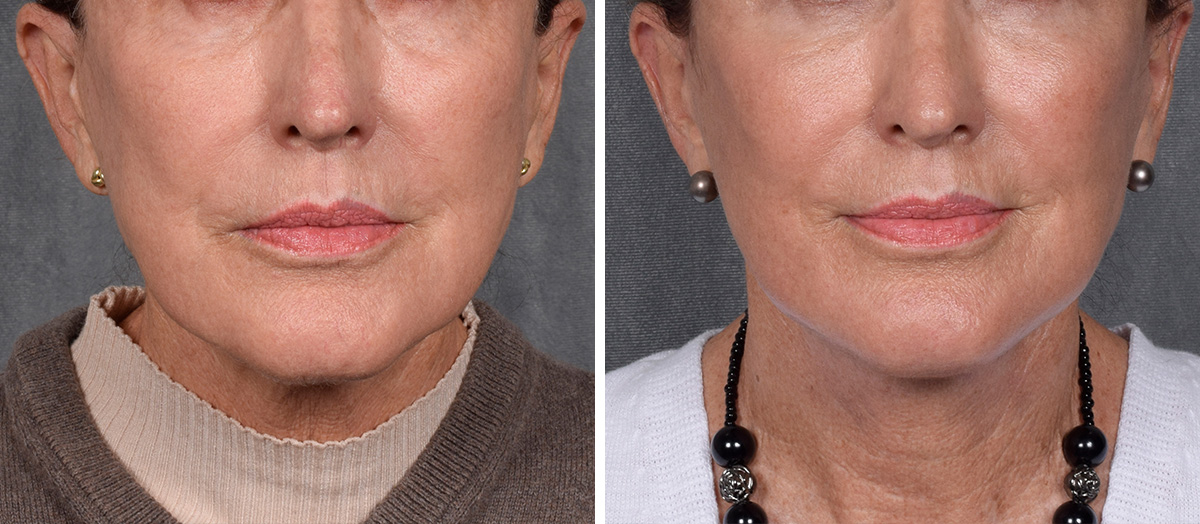 Neck Lift Before & After Gallery - Patient 162270 - Image 4