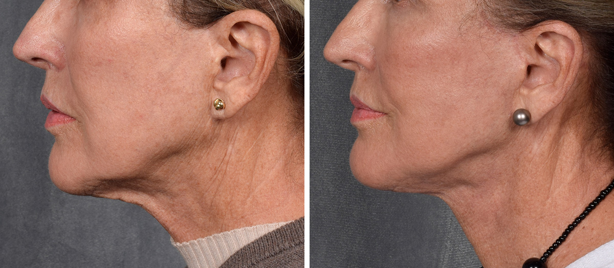 Neck Lift Before & After Gallery - Patient 162270 - Image 6