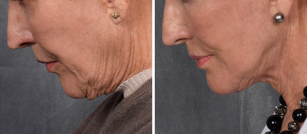 Neck Lift Before & After Gallery - Patient 162270 - Image 7