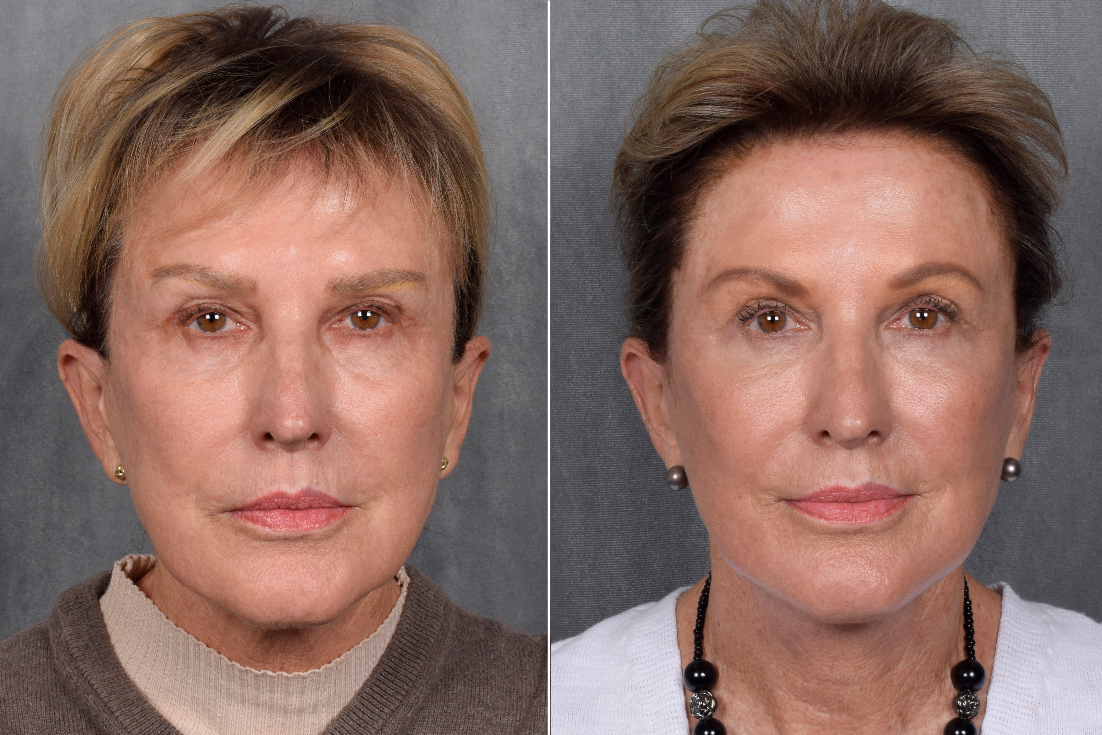 Neck Lift Before & After Gallery - Patient 162270 - Image 11