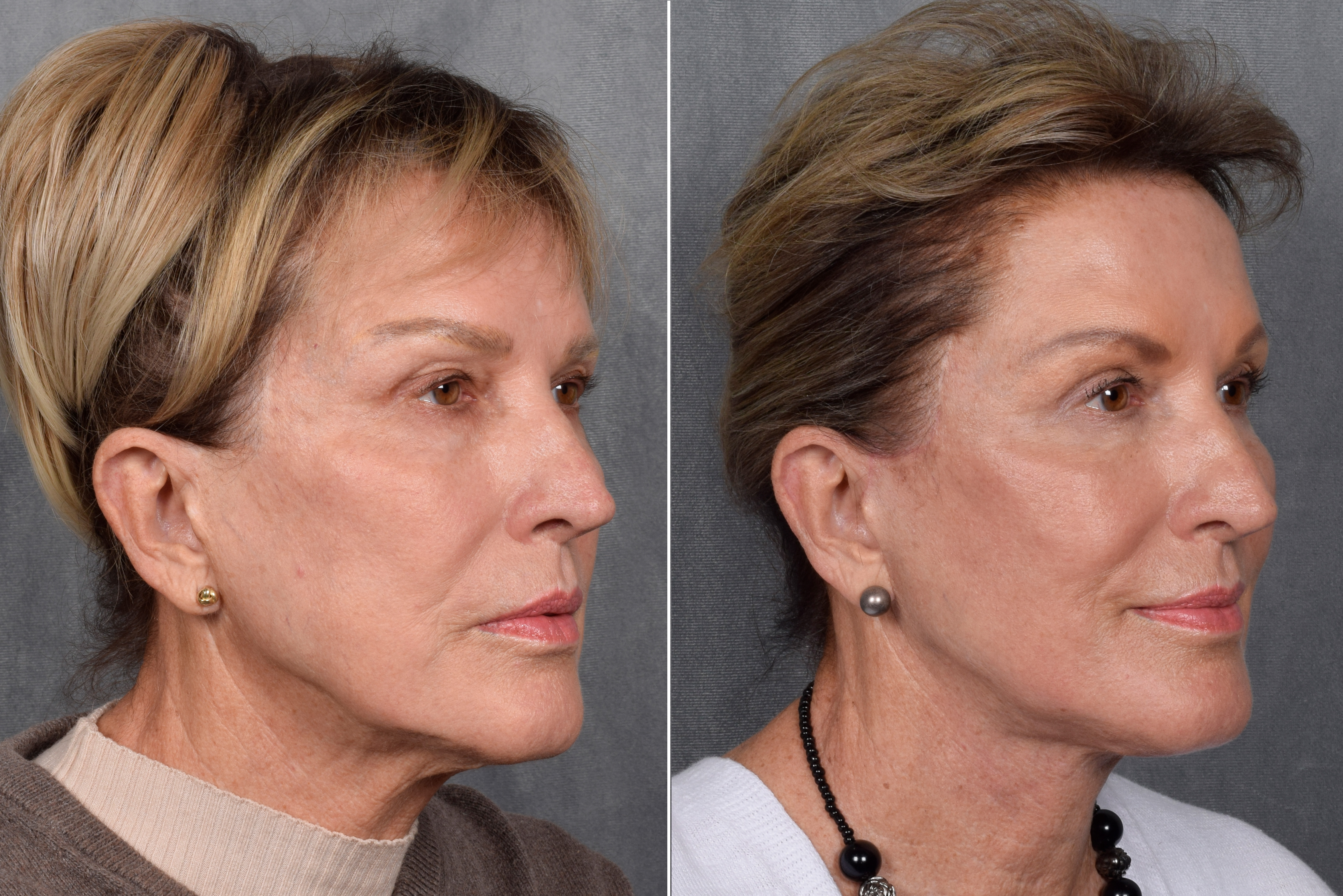 Neck Lift Before & After Gallery - Patient 162270 - Image 8