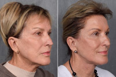 CO2 Laser Before & After Gallery - Patient 402443 - Image 1