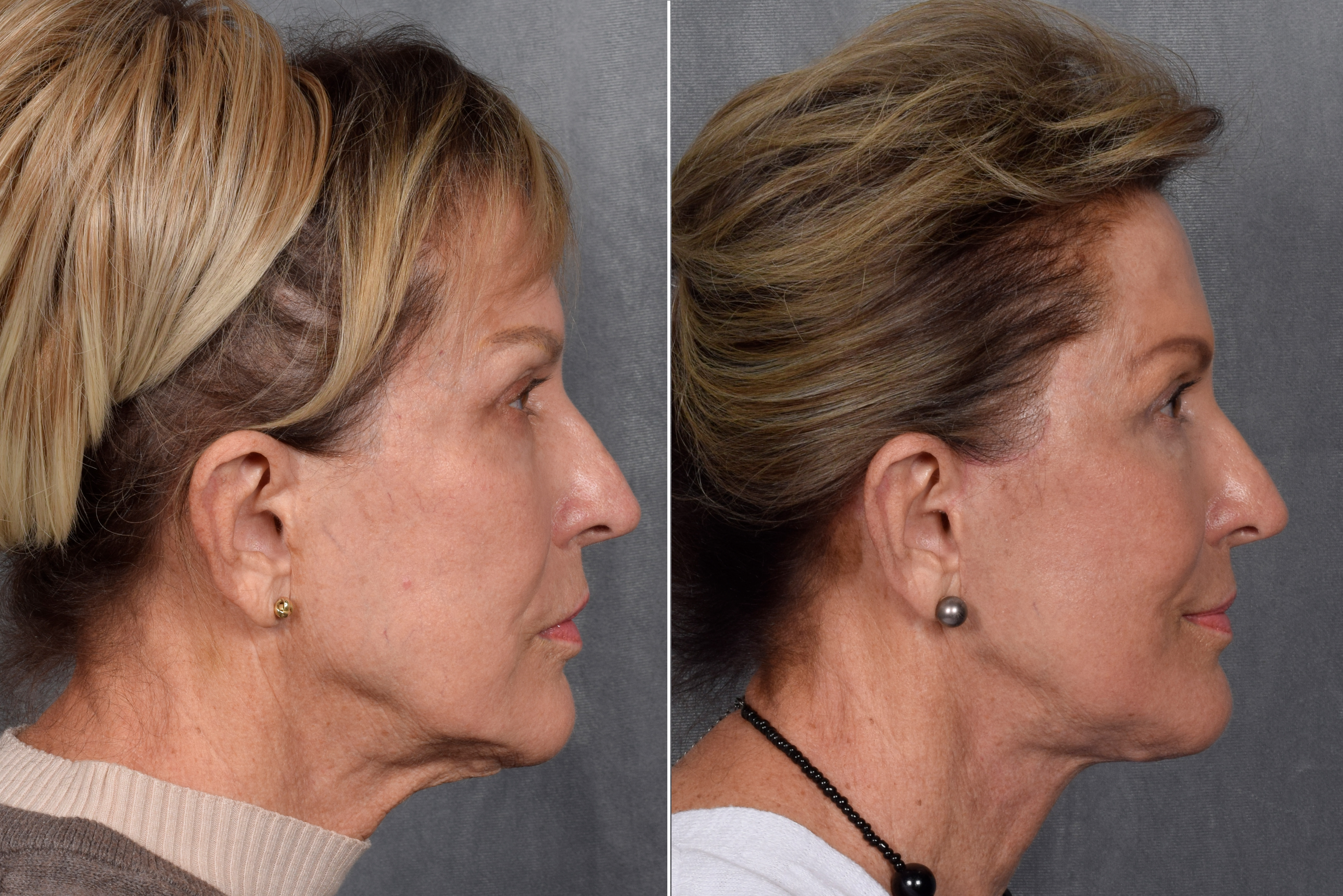 Neck Lift Before & After Gallery - Patient 162270 - Image 9