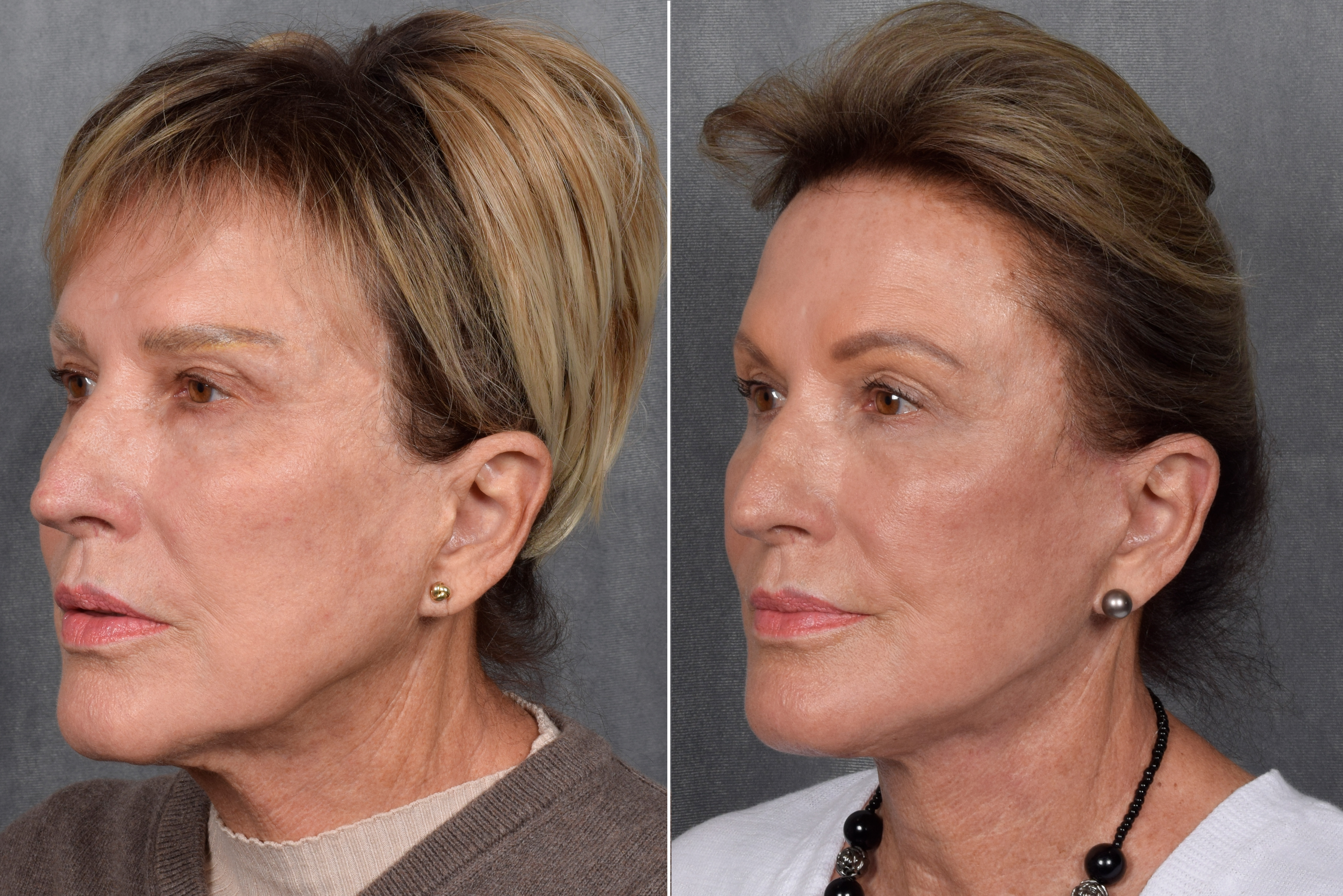 Neck Lift Before & After Gallery - Patient 162270 - Image 12