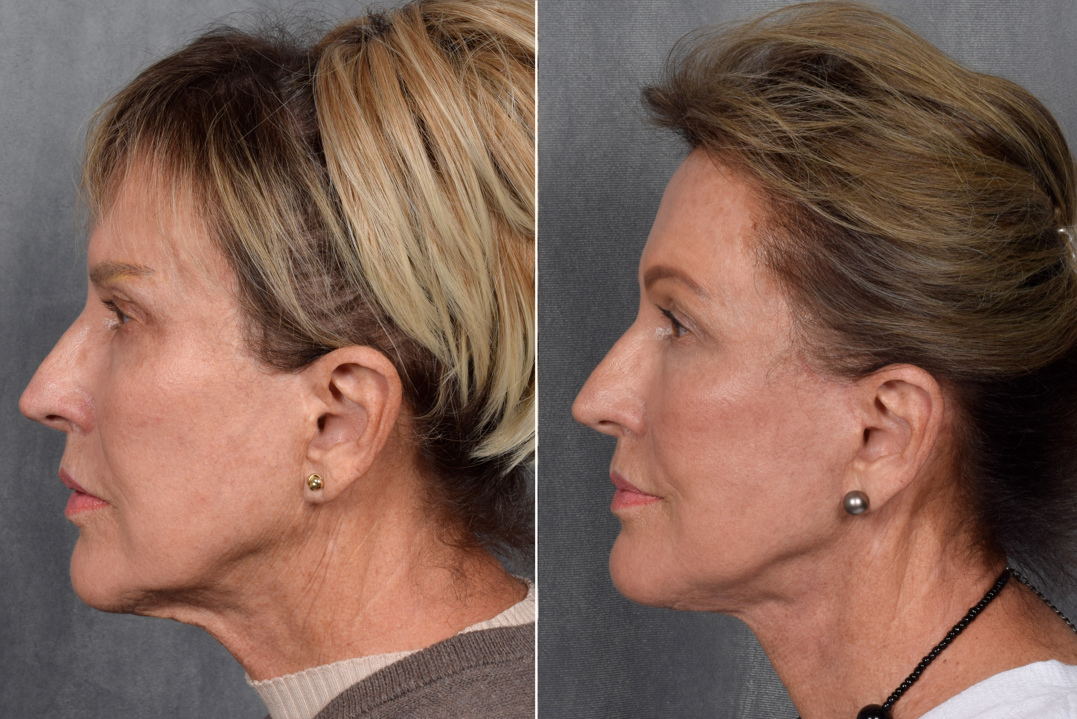 Neck Lift Before & After Gallery - Patient 162270 - Image 13
