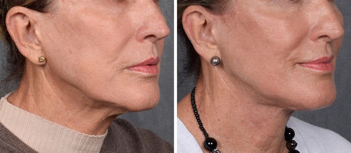Neck Lift Before & After Gallery - Patient 162270 - Image 1