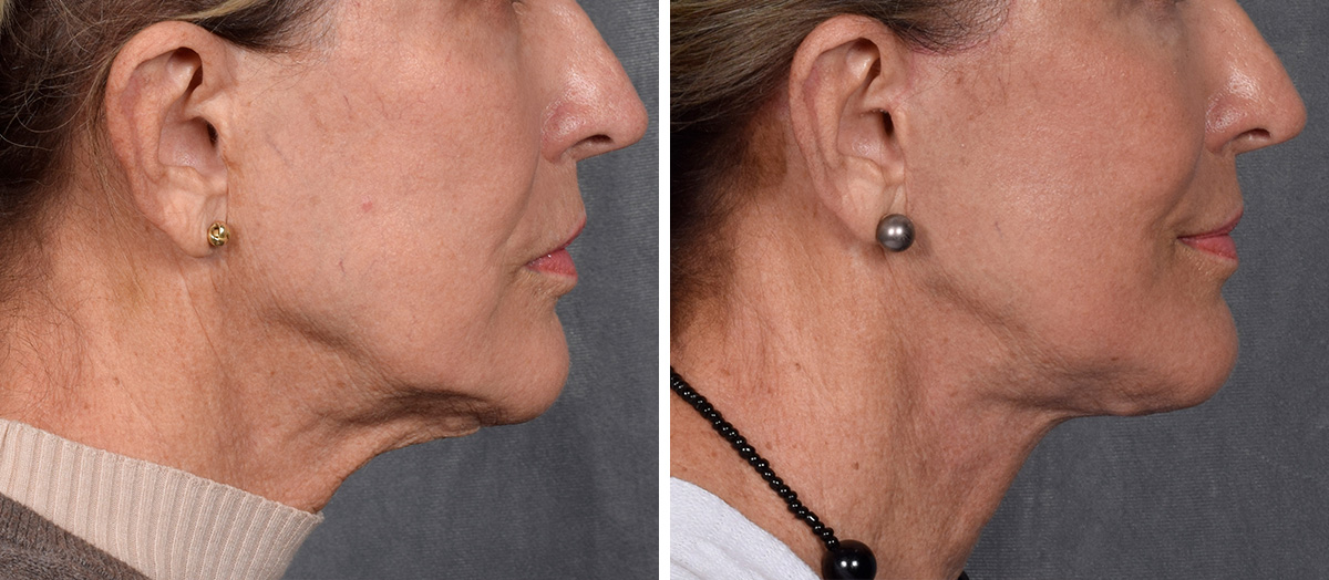 Neck Lift Before & After Gallery - Patient 162270 - Image 2