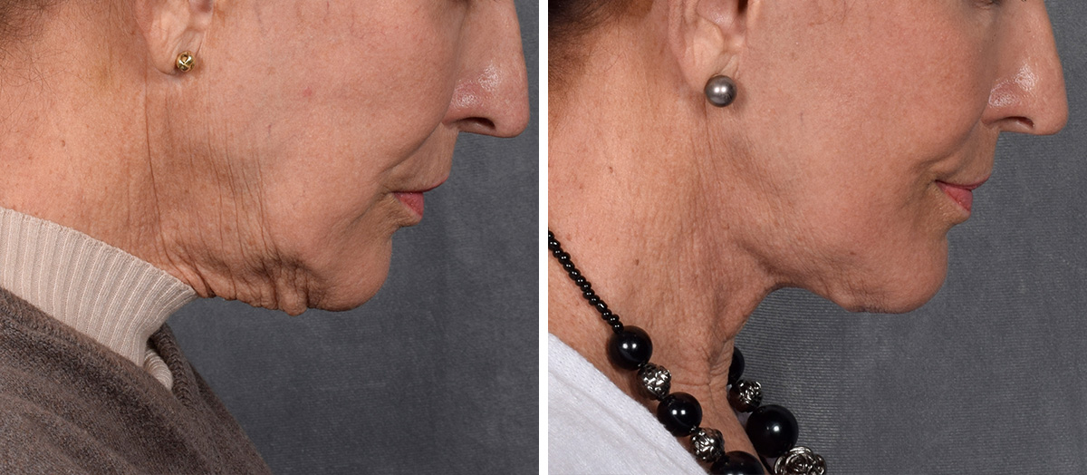 Neck Lift Before & After Gallery - Patient 162270 - Image 3