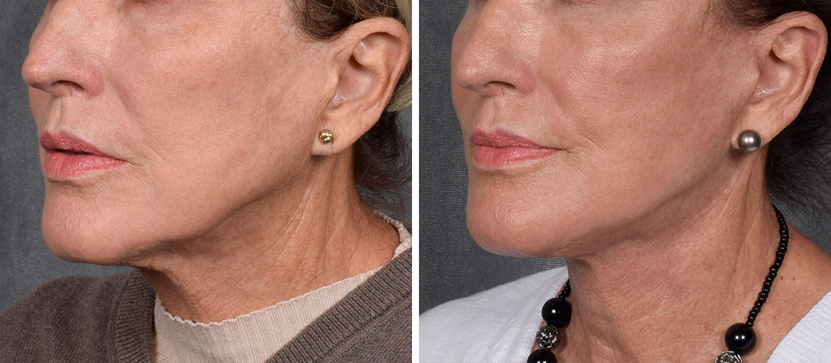 Neck Lift Before & After Gallery - Patient 162270 - Image 5