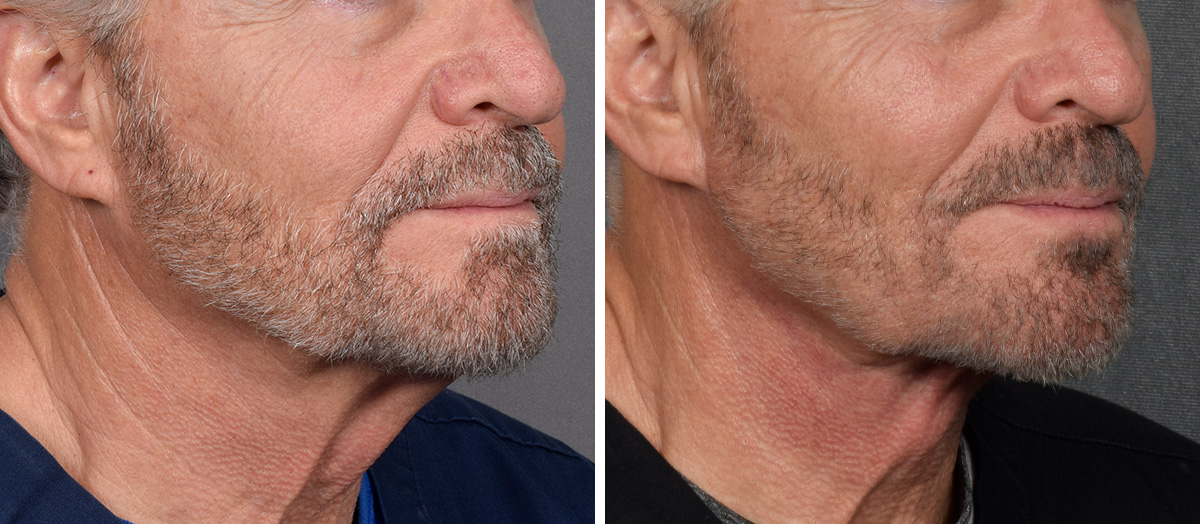 Neck Lift Before & After Gallery - Patient 191619 - Image 1