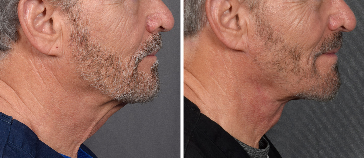 Neck Lift Before & After Gallery - Patient 191619 - Image 2
