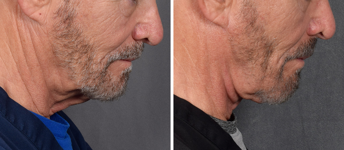 Neck Lift Before & After Gallery - Patient 191619 - Image 3