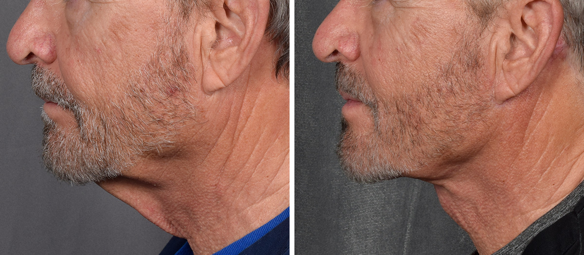 Neck Lift Before & After Gallery - Patient 191619 - Image 6