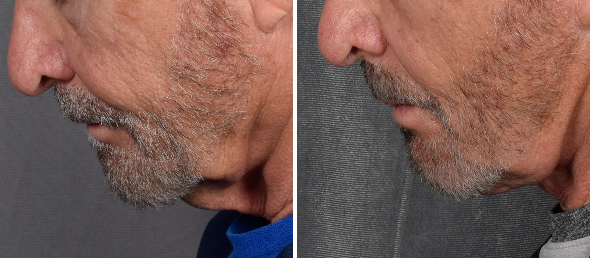 Neck Lift Before & After Gallery - Patient 191619 - Image 7