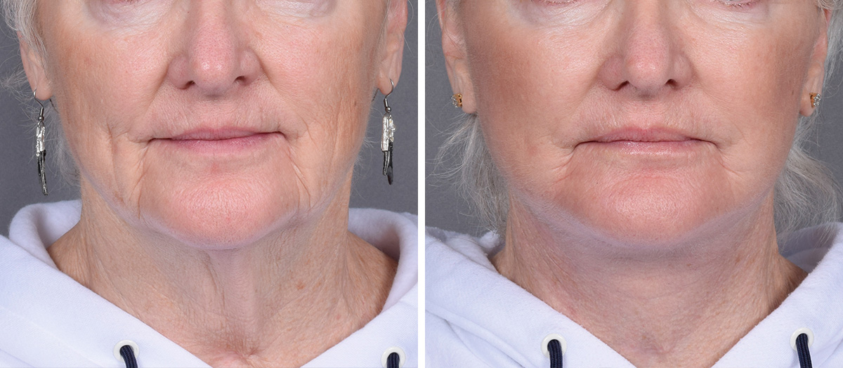 Neck Lift Before & After Gallery - Patient 265755 - Image 3