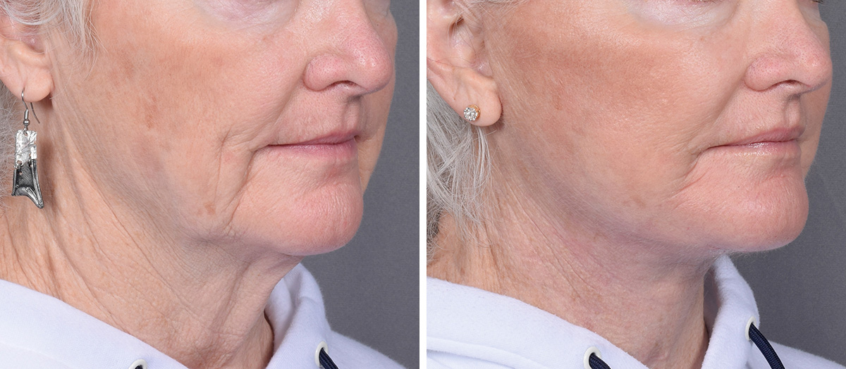 Neck Lift Before & After Gallery - Patient 265755 - Image 1
