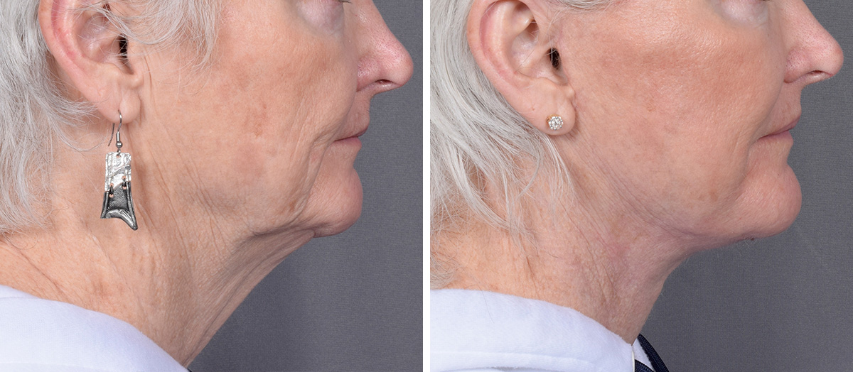 Neck Lift Before & After Gallery - Patient 265755 - Image 2