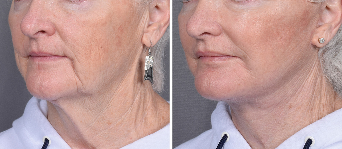 Neck Lift Before & After Gallery - Patient 265755 - Image 4
