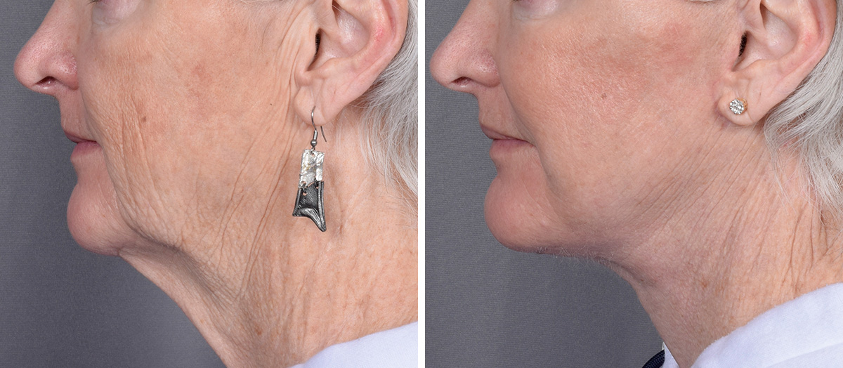 Neck Lift Before & After Gallery - Patient 265755 - Image 5