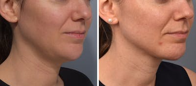 Neck Lift Before & After Gallery - Patient 422422 - Image 1