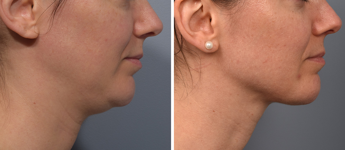 Neck Lift Before & After Gallery - Patient 422422 - Image 2