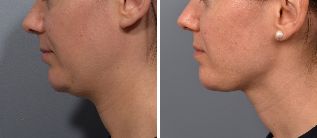 Neck Lift Before & After Gallery - Patient 422422 - Image 5