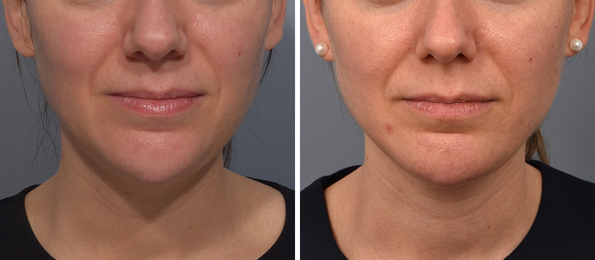Neck Lift Before & After Gallery - Patient 422422 - Image 3