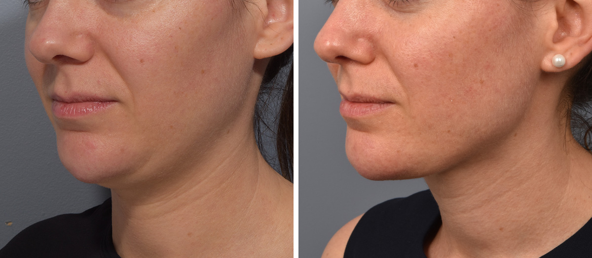 Neck Lift Before & After Gallery - Patient 422422 - Image 4