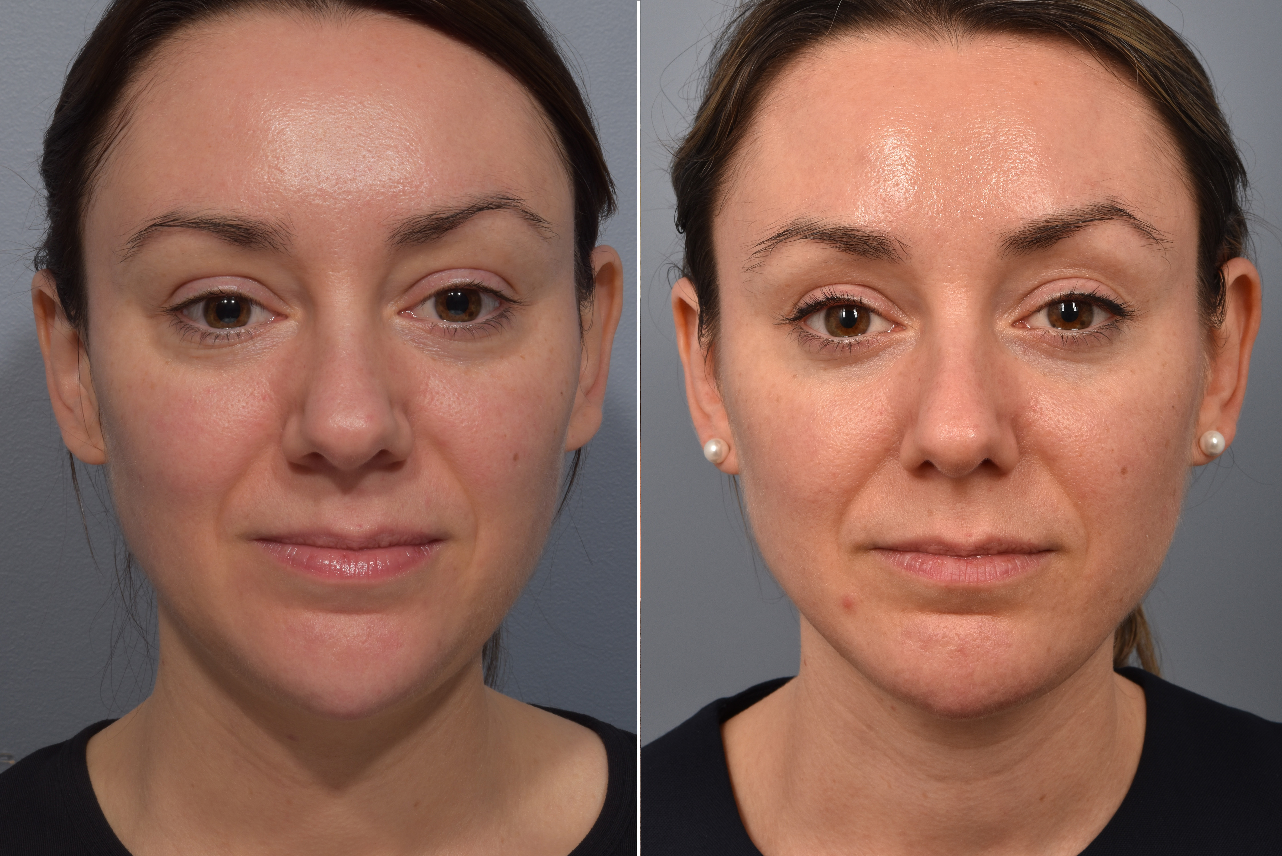 Neck Lift Before & After Gallery - Patient 422422 - Image 8