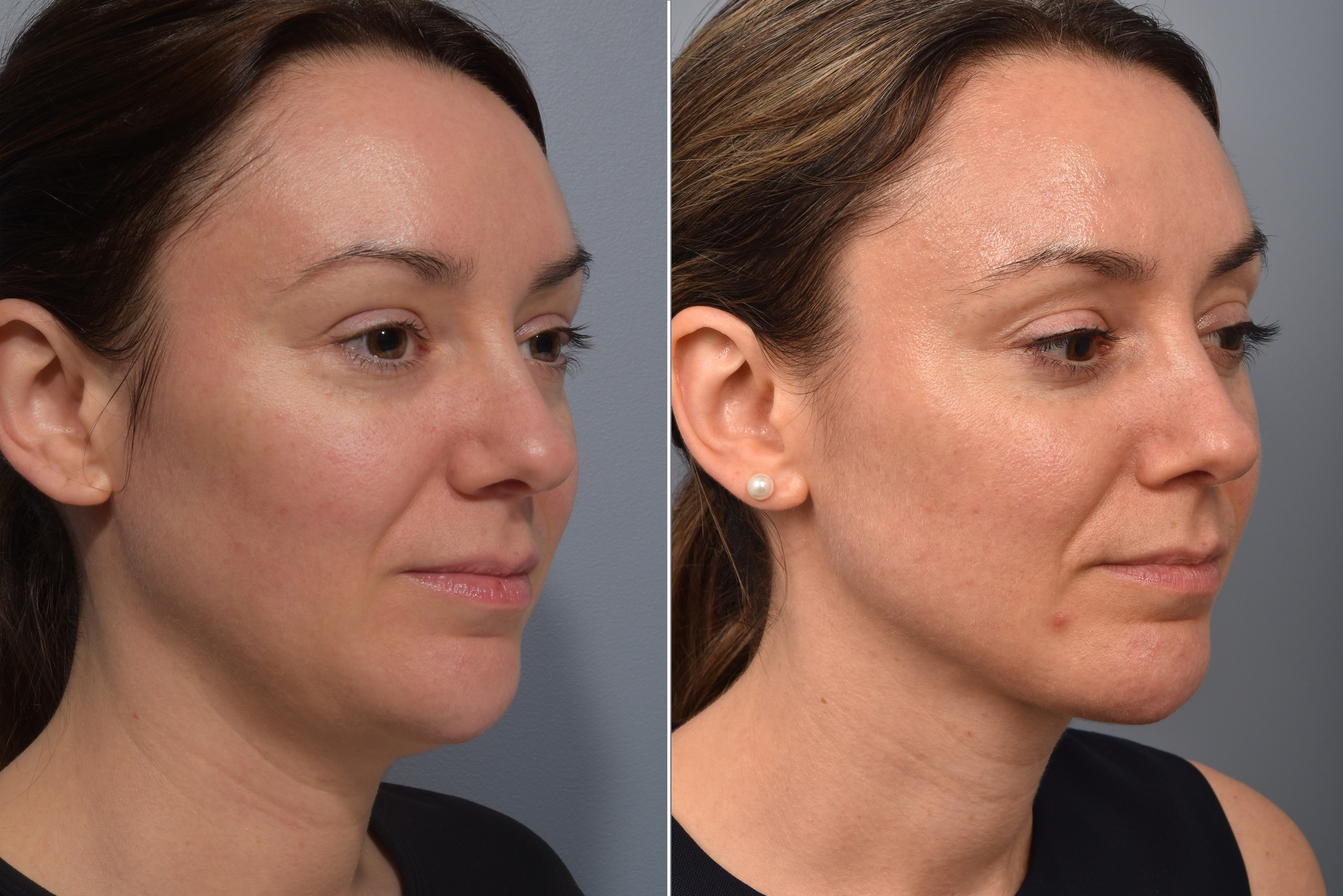 Neck Lift Before & After Gallery - Patient 422422 - Image 6